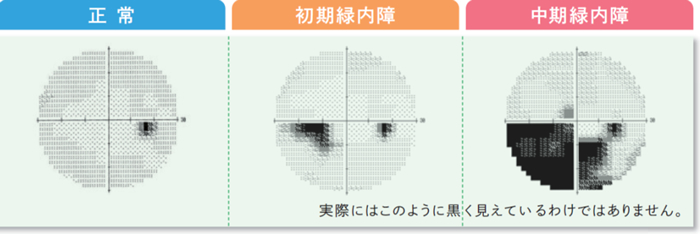 ハンフリー視野計