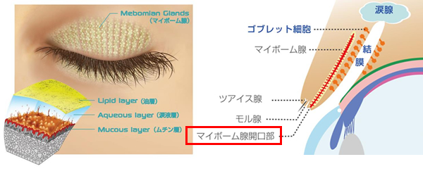 涙液蒸発亢進型ドライアイ