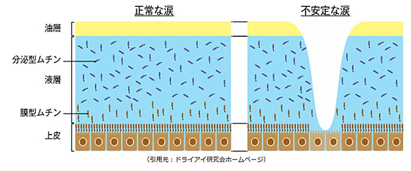 涙液蒸発亢進型ドライアイ